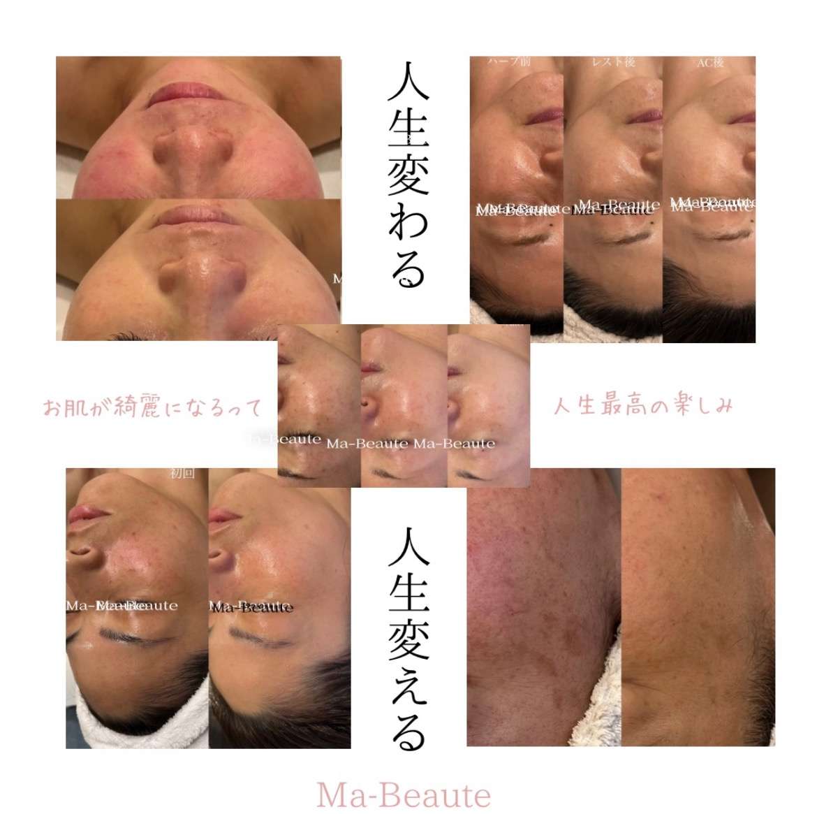 本気のアンチエイジングからニキビニキビ跡までどんな肌悩みも改善!