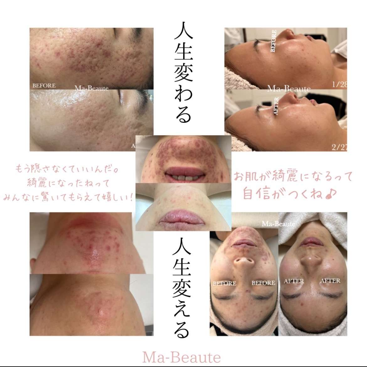 長年繰り返してきたニキビ撲滅!もう悩まない!