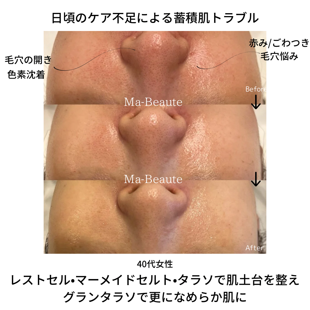 肌のごわつき毛穴悩み