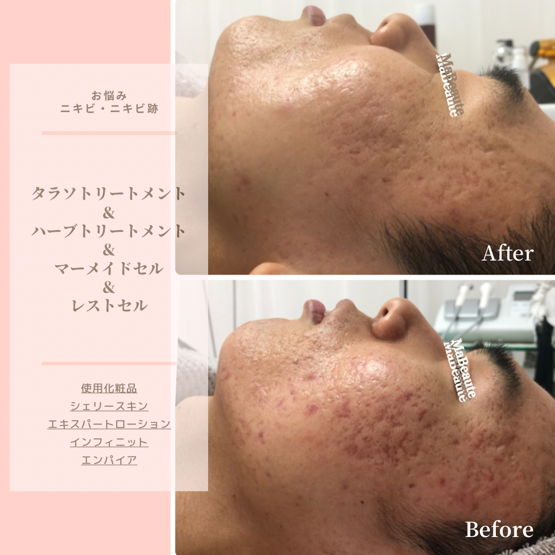 何をしても治らなかった長年の繰り返すニキビ/ニキビ跡改善