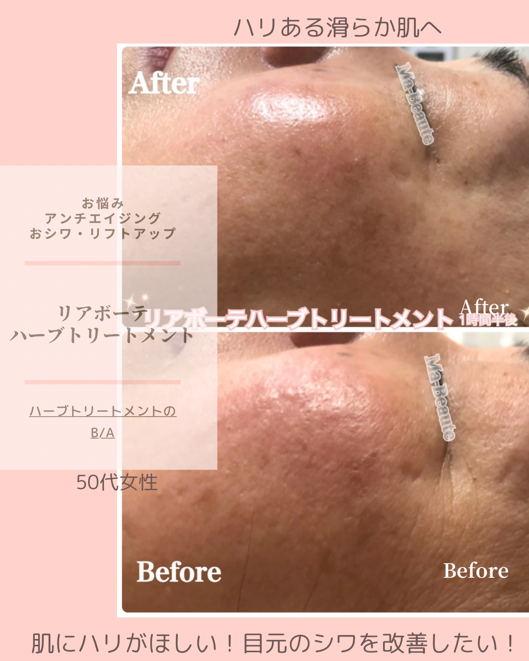 目元のシワを改善!ハリある肌へ